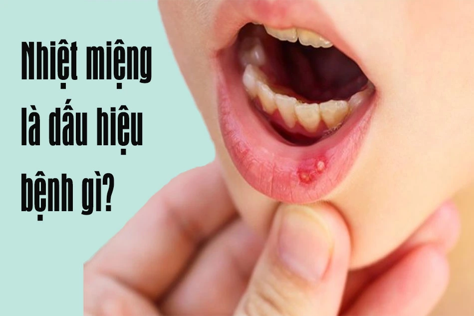[Giải đáp] Hay bị nhiệt miệng là dấu hiệu của bệnh gì?