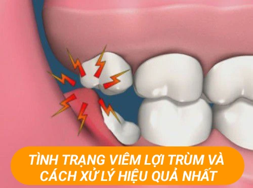 Tình trạng viêm lợi trùm và cách xử lý hiệu quả nhất