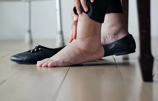 Tràn dịch cổ chân nặng ảnh hưởng đến đi lại có thể thực hiện hút dịch tràn để giảm đau, cải thiện vận động