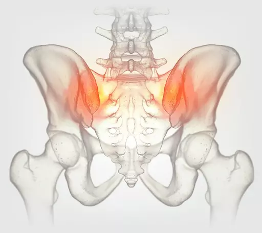 Viêm khớp cùng chậu xảy ra ở vị trí giữa xương sống và xương chậu ở gần hông 