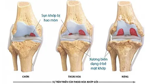 Thoái hóa khớp tràn dịch là tình trạng các đầu xương bị bào mòn dần, sụn không còn chức năng bảo vệ khớp gây viêm, thoái hóa và tràn dịch