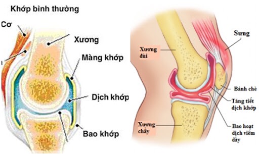 Viêm bao hoạt dịch khớp: Tất cả những điều bạn cần biết