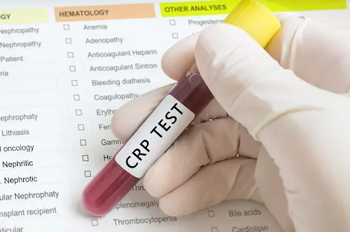Xét nghiệm CRP giúp đánh giá mức độ viêm khớp của người bệnh