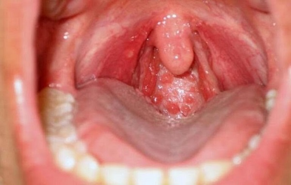 Viêm họng hạt mô tả việc đáy lưỡi nổi những hạt nhỏ gây đau rát và khó nuốt