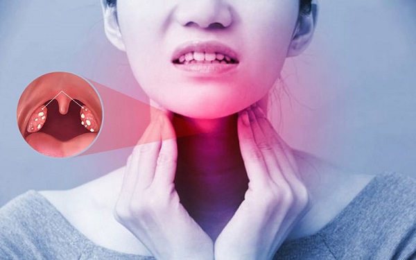 Đau rát họng khó nuốt là triệu chứng đặc trưng của viêm amidan