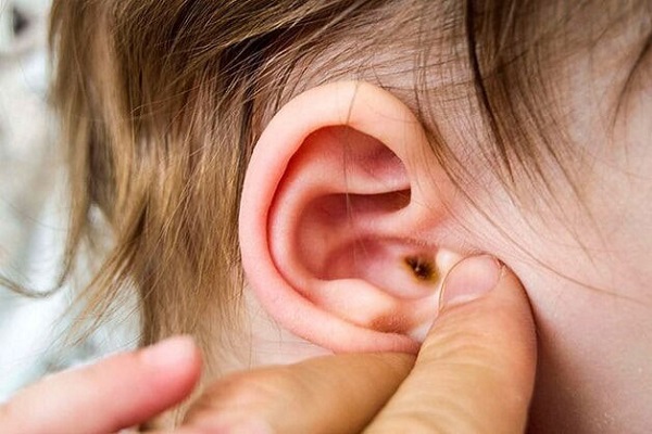 Nhiễm trùng ở cổ họng có thể lan đến tai gây ra viêm tai giữa