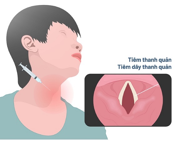 Điều trị liệt dây thanh quản theo chỉ định của bác sĩ