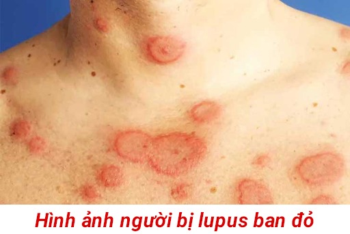 Lupus ban đỏ: Nguyên nhân, dấu hiệu, chẩn đoán và điều trị