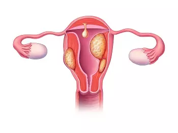 U xơ tử cung là bệnh phụ khoa phổ biến ở nữ giới