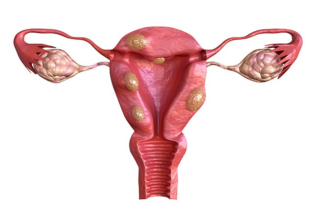 uterine-fibroid-reproduction-benign-tumors-uterus-ovaries.jpg