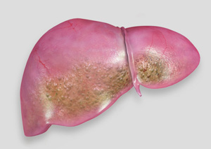 fatty-liver-disease.jpg