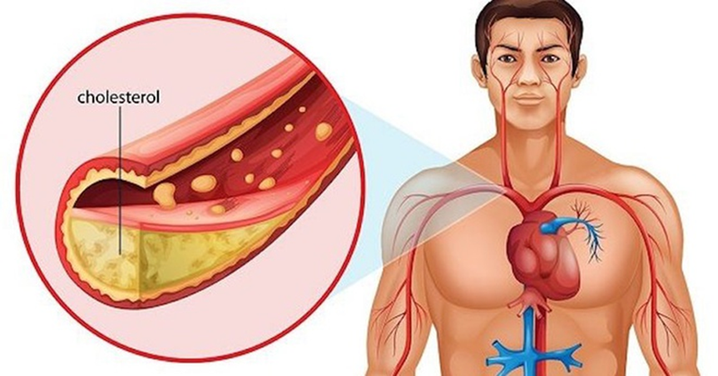 Cholesterol tăng cao có thể gây xơ vữa động mạch, cản trở lưu thông máu