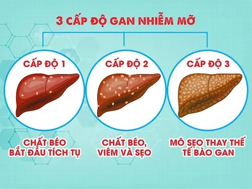 Dựa theo lượng chất béo, gan nhiễm mỡ chia thành 3 cấp độ