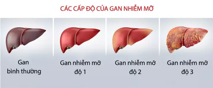 Gan nhiễm mỡ độ 3 là giai đoạn nguy hiểm nhất, có nguy cơ tiến triển thành xơ gan, ung thư gan