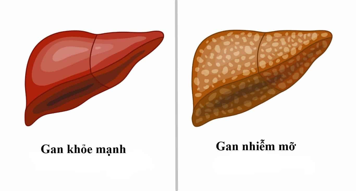 Gan nhiễm mỡ có mấy cấp độ, cấp độ nào nguy hiểm nhất?