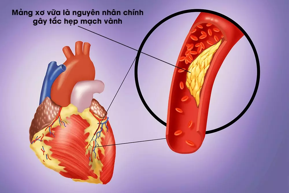 Mỡ máu cao có thể gây ra bệnh mạch vành