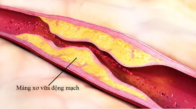 Xơ vữa động mạch là tình trạng mảng bám chứa chất béo, cholesterol tích tụ lại ở thành mạch gây hẹp mạch, cản trở lưu thông máu