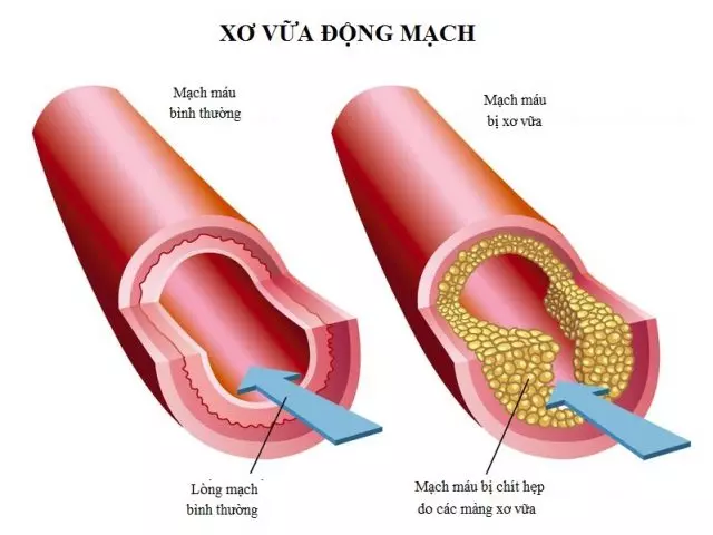 Xơ vữa động mạch khiến lòng mạch hẹp lại, cản trở lưu thông máu