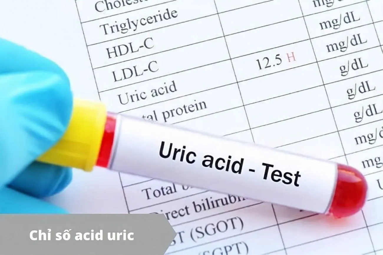 Acid uric 450 mmol/lít là cao hay thấp? Đã bị bệnh gout chưa?