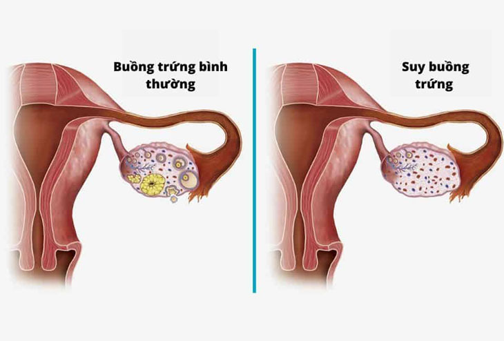 Suy buồng trứng dẫn đến giảm nội tiết tố nữ