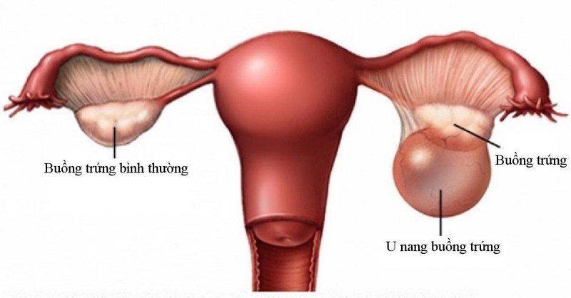 U nang buồng trứng tăng nguy cơ bốc hỏa tiền mãn kinh