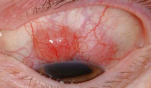 Ung thư mắt - Tất tần tật những thông tin quan trọng cần biết