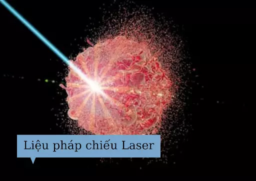 lieu-phap-chieu-laser-trong-dieu-tri-ung-thu-da-day-giai-doan-cuoi.webp