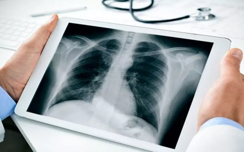 Chụp X-quang để chẩn đoán tình trạng của phổi