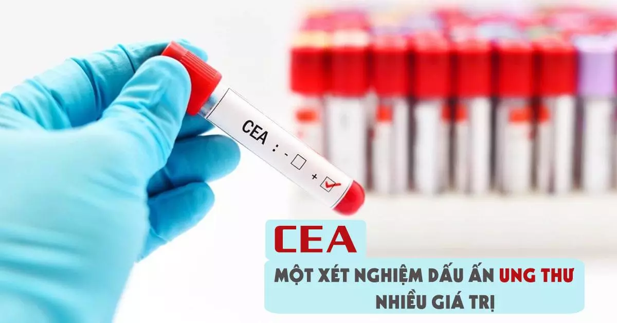 Xét nghiệm dấu ấn ung thư CEA xác định chỉ số bình thường hay bất thường