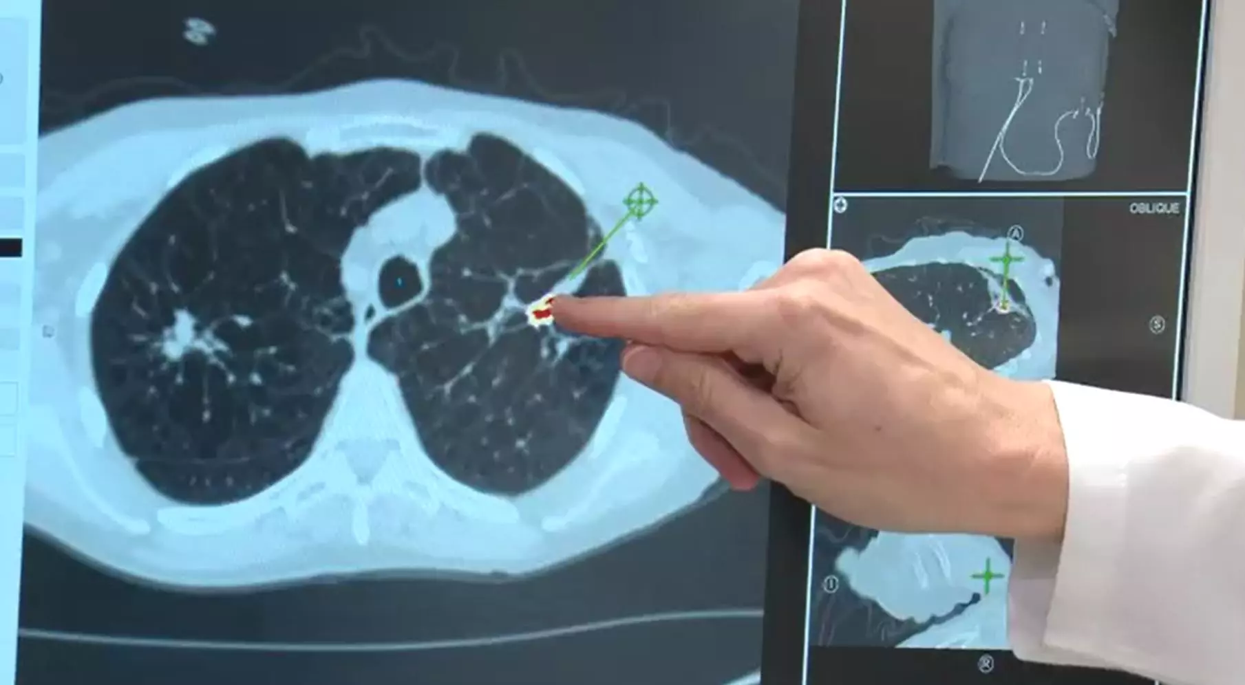 Ung thư phổi giai đoạn 4 là giai đoạn muộn của bệnh