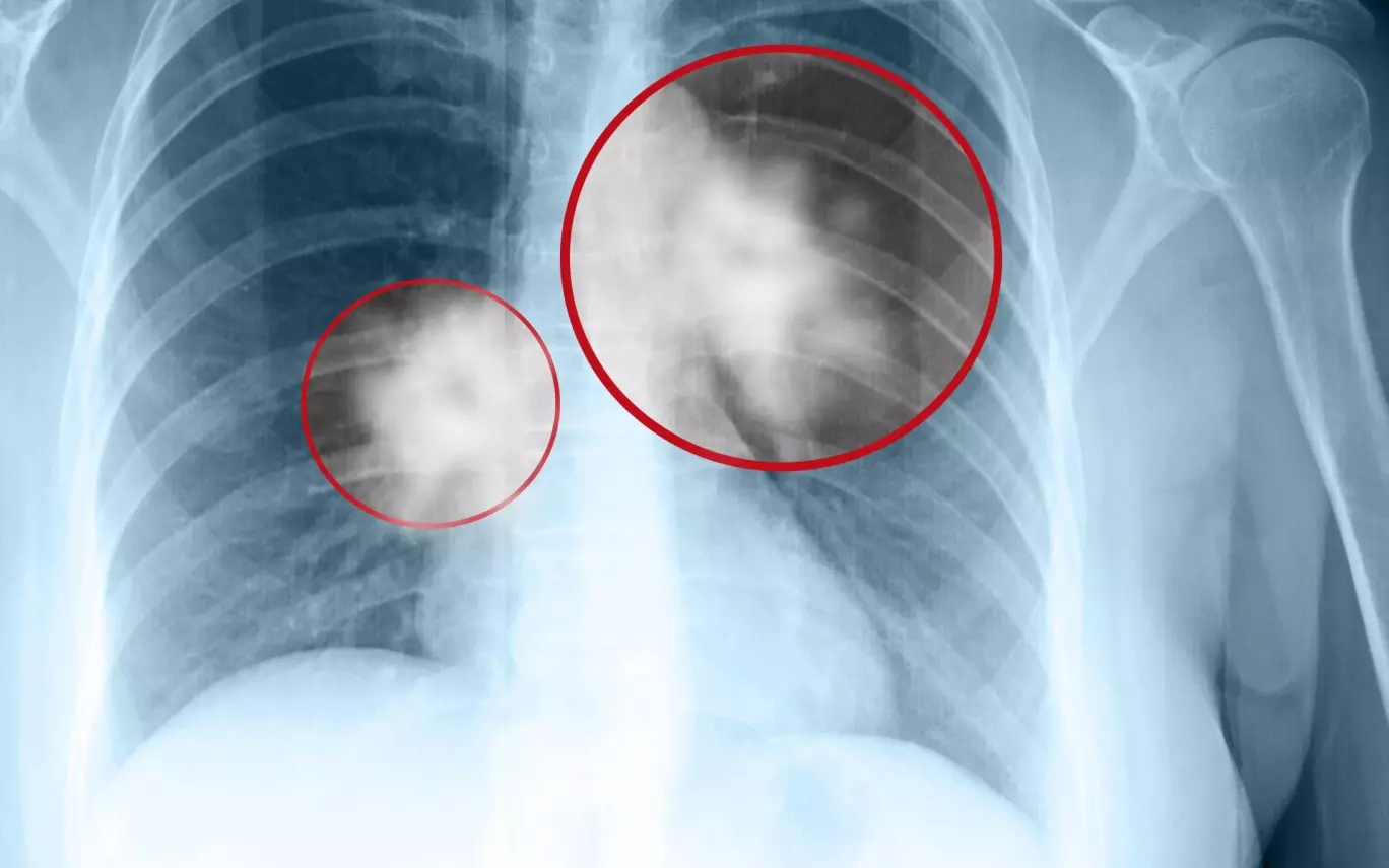 Chẩn đoán bệnh ung thư phổi bằng chụp X-quang, chụp CT