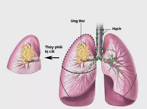 Ung thư phổi có mấy giai đoạn? Đặc điểm và mức độ nguy hiểm
