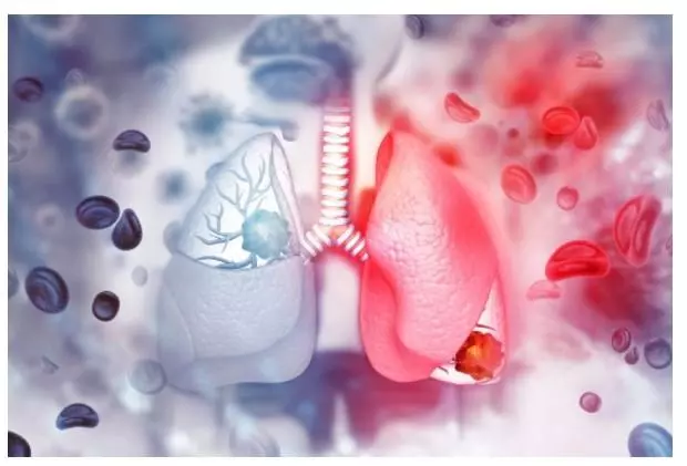Ung thư phổi tế bào nhỏ có 2 giai đoạn: Hạn chế và mở rộng