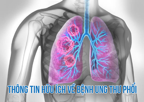 Ung thư phổi - Dấu hiệu, nguyên nhân và phương pháp điều trị