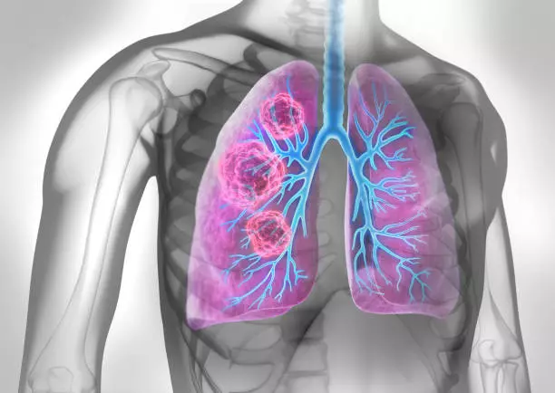Bệnh u phổi và những hậu quả kinh hoàng bạn không thể bỏ qua