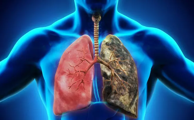 Tầm soát ung thư phổi có thể gây nững rủi ro nhất định