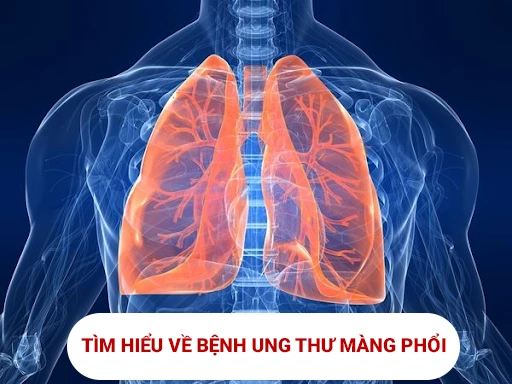 Ung thư màng phổi: Nguyên nhân, dấu hiệu và cách điều trị 