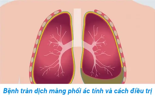 Tìm hiểu về tràn dịch màng phổi ác tính và cách điều trị