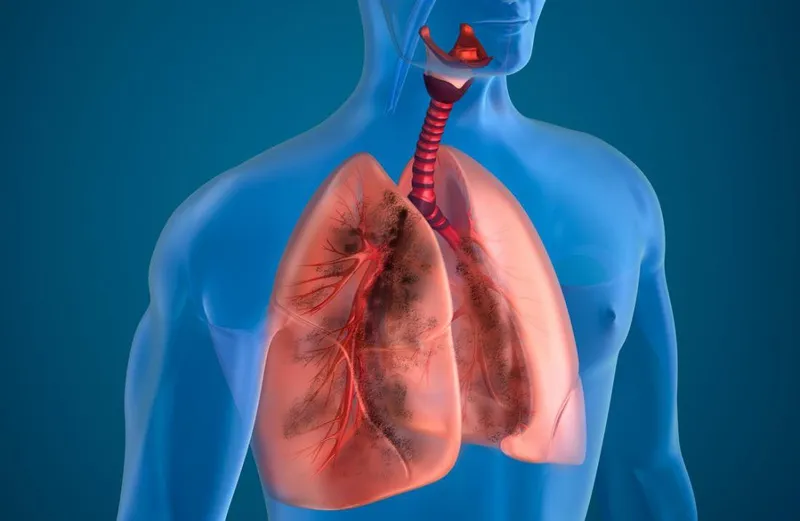 Giải đáp: Bệnh phổi tắc nghẽn mạn tính có chữa được không?