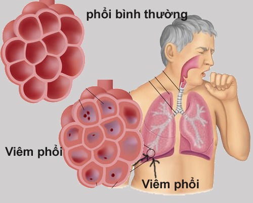 Ho khan kéo dài có thể là do bệnh lý viêm phổi gây ra