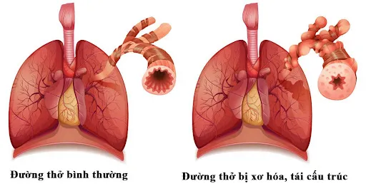Tái cấu trúc đường thở chính là một trong những nguyên nhân dẫn đến bệnh viêm phế quản tái phát