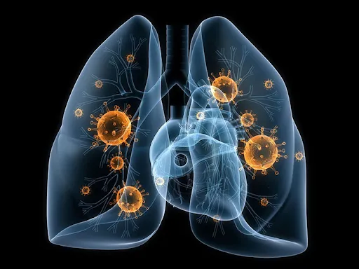 Vi khuẩn và virus là những tác nhân thường gặp gây ra bệnh viêm phổi