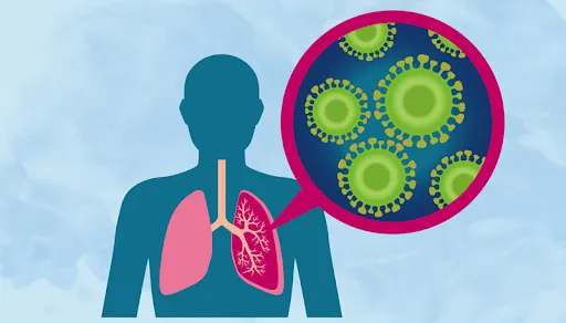 Viêm phổi là tình trạng nhiễm trùng nhu mô phổi gây nhiều biến chứng nghiêm trọng