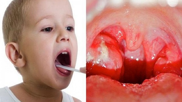 Viêm họng mủ ở trẻ em gây nhiều triệu chứng khó chịu 