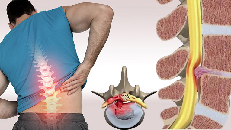 Bị tho&aacute;t vị đĩa đệm c&oacute; chữa được kh&ocirc;ng?