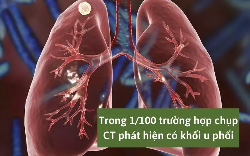 Chụp CT có thể giúp phát hiện khối u ở phổi