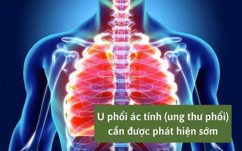 Trong một số trường hợp, u phổi lành tính có thể chuyển thành ung thư phổi