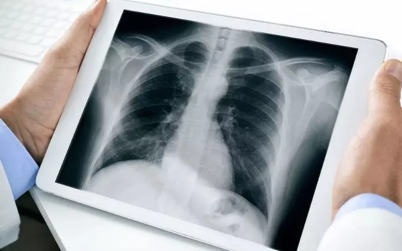 Xét nghiệm hình ảnh thường được sử dụng để tìm ra các khối u phổi