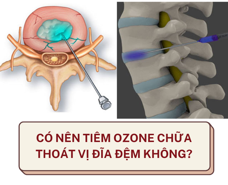 Đau thần kinh tọa là gì