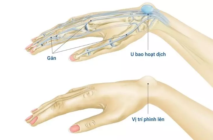 U nang bao hoạt dịch khớp cổ tay có cần thực hiện phẫu thuật hay không?